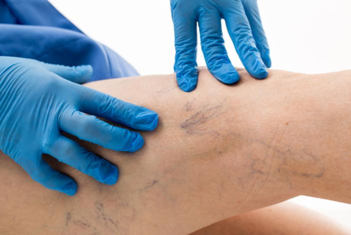 El 70 % de mexicanos adultos tienen el riesgo de padecer la enfermedad venosa crónica