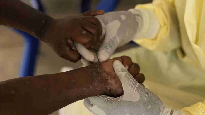 México registra 49 casos de mpox distribuidos en 11 estados