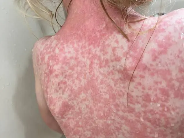 Michoacán contabiliza 139 casos de sarampión ubicado en tercer lugar a nivel nacional