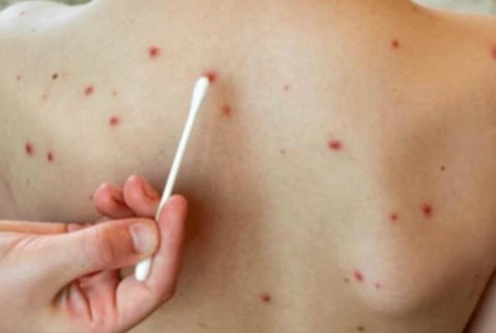 Michoacán, sexto lugar nacional en casos de sarampión