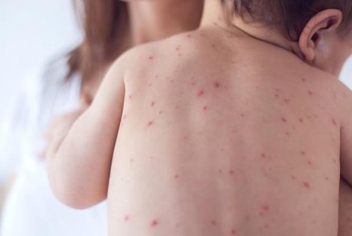 ¿Qué es la "dosis cero"? SSM explica cómo proteger a bebés contra el sarampión