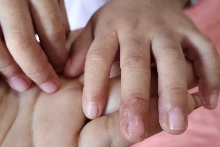 SSM descarta brote de virus de Coxsackie en la entidad