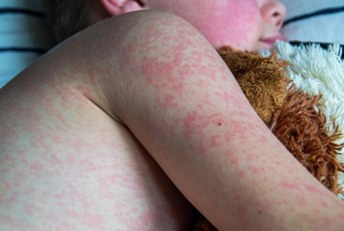 Suben a cuatro los bebés fallecidos por el brote de sarampión en Guatemala